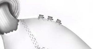 تدبيس المعدة “يقلل احتمال الاصابة بالسرطان”