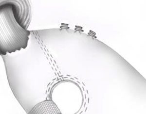 تدبيس المعدة “يقلل احتمال الاصابة بالسرطان”